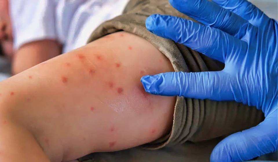 Measles alert in Mexico City: how it spreads and vaccination points