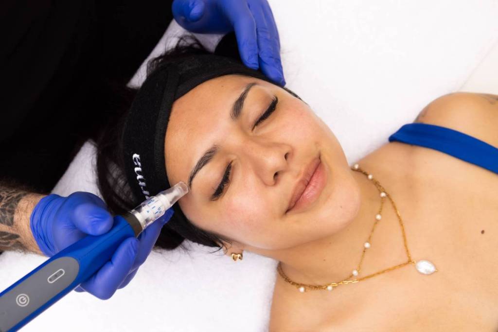 microneedling at spa derma