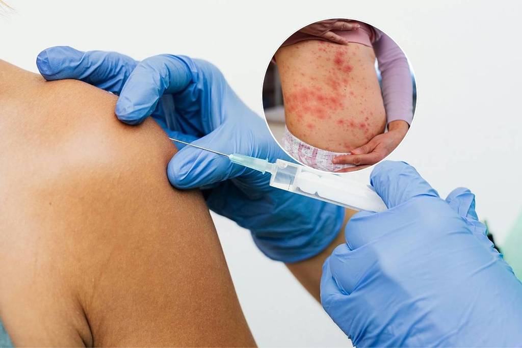 measles outbreak in Singapore everything you need to know