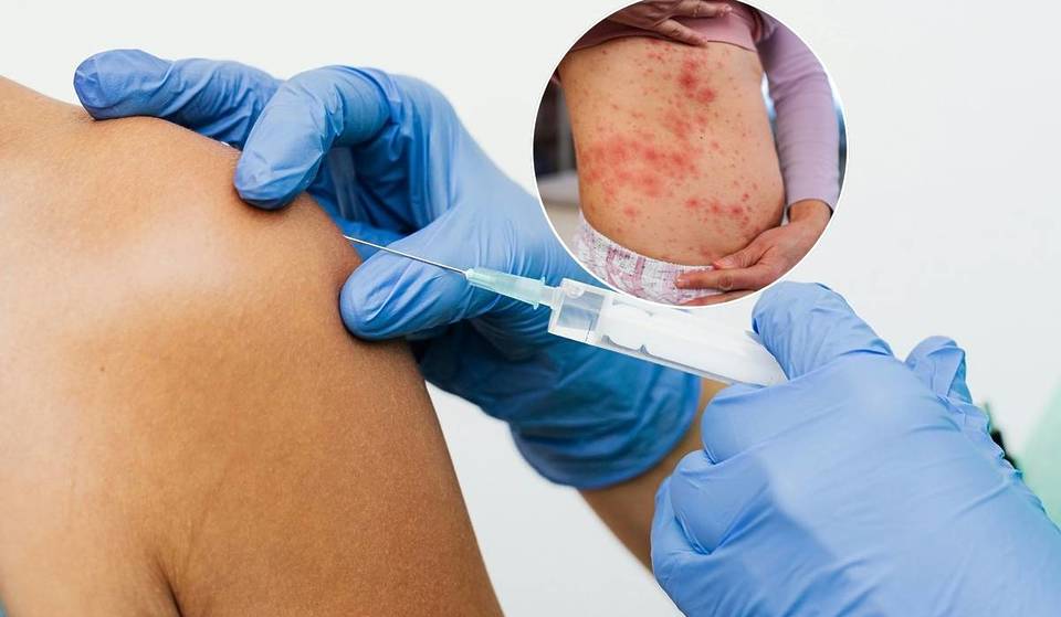Singapore’s Measles Spike 2026: Everything You Need To Know